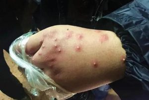 红火蚁咬伤图片