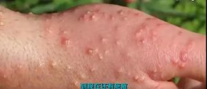 被红火蚁咬后的特征